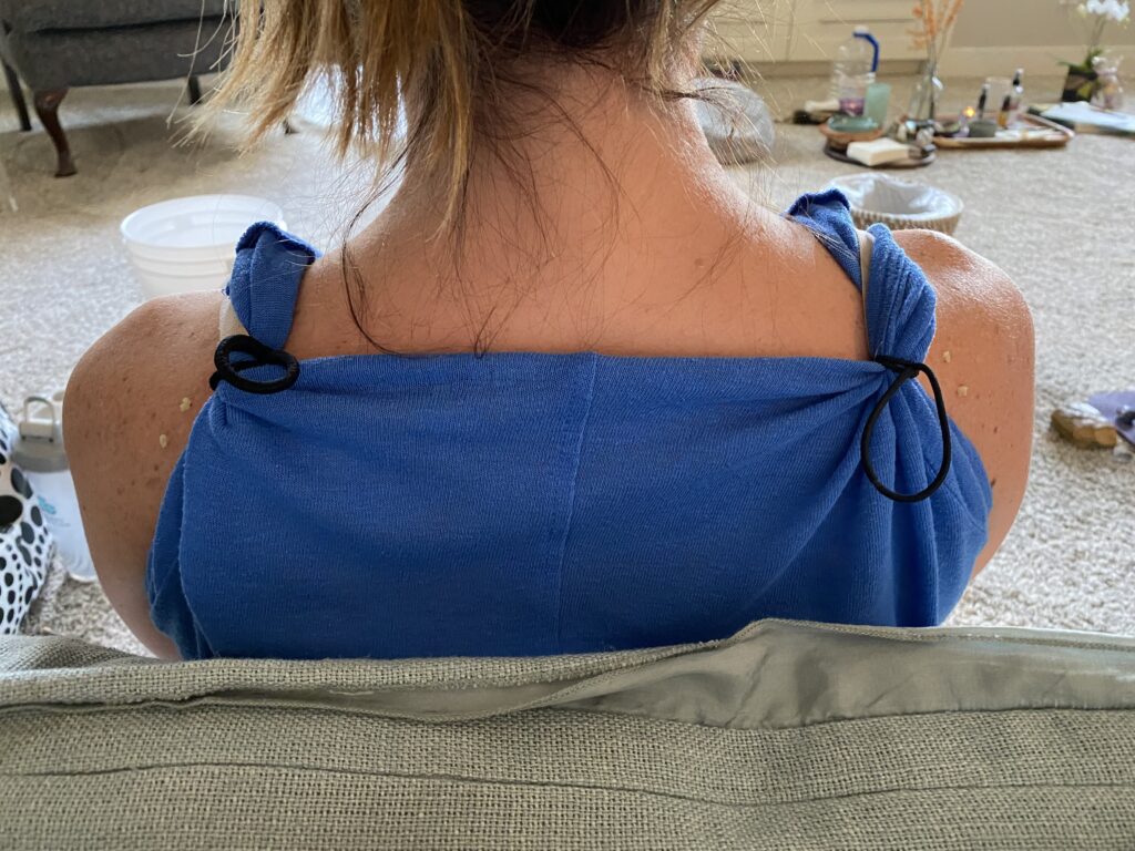 Andie during a Kambo ceremony having Kambo applied to her back.